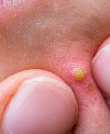 Uzmanı uyardı: Sivilce deyip geçmeyin, ölüme kadar götürüyor 5 1731316167_ZI8d-8DgXEy76Fv0Y8pOSQ.jpg