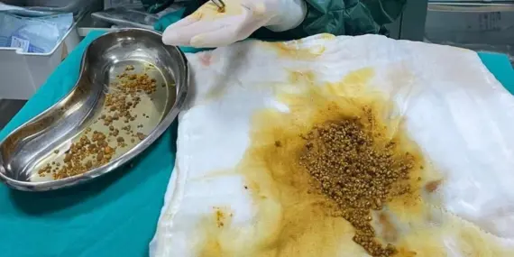 Safra Kesesinden Çıkanlar Doktorları Bile Şaşırttı 7 haberrr